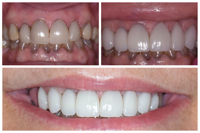 Before & After Anterior Crowns