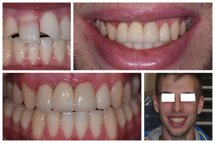 Before & After Trauma Implants and Crowns