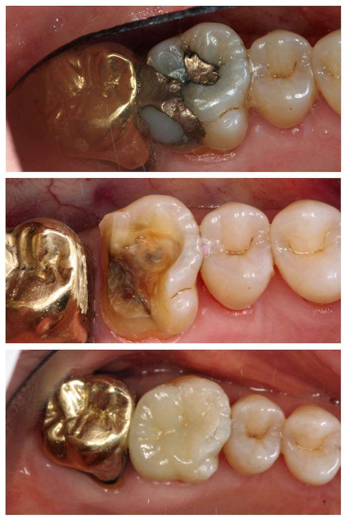 Before & After Porcelain Onlay