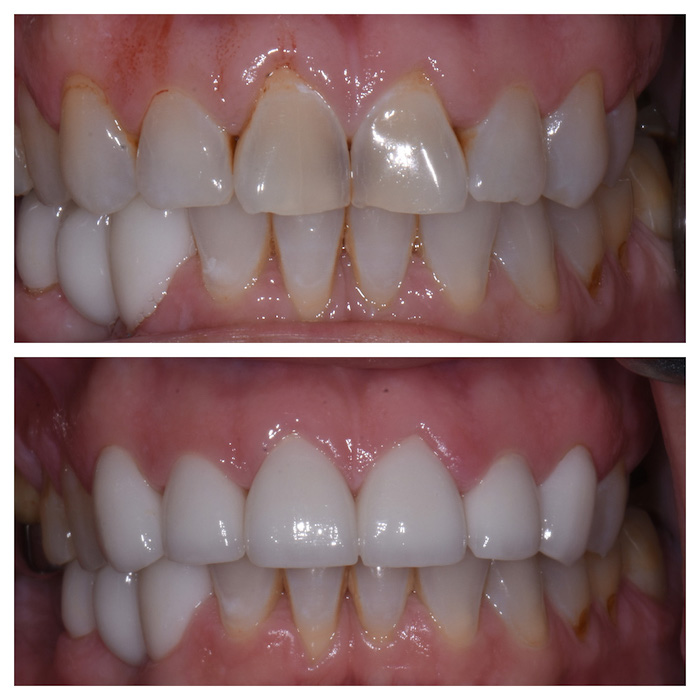 Before & After Anterior Crowns